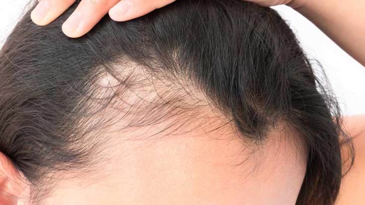 Causas de queda de cabelo em mulheres após os 40