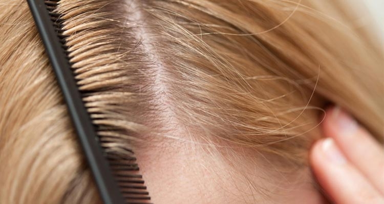 Máscaras caseiras de caspa para cabelo