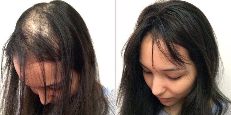 Народни средства за косопад при жени у дома