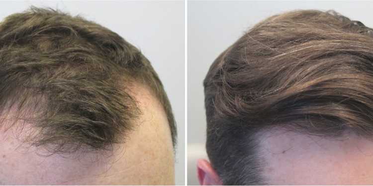 Restauração capilar de jack