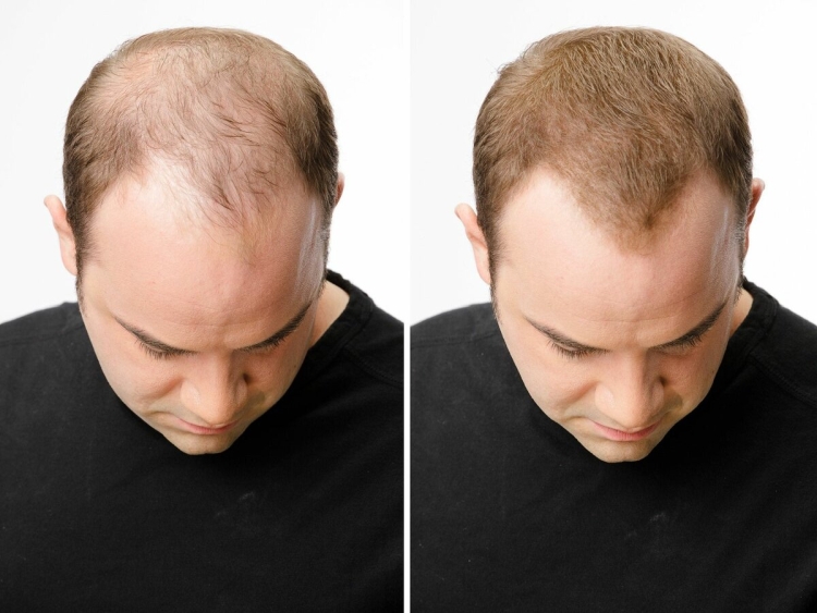 Restauração capilar de jack