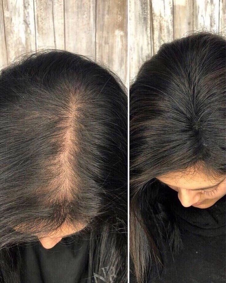 Queda de cabelo por estresse