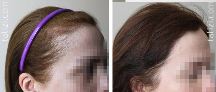 Terapia de ozônio para o couro cabeludo