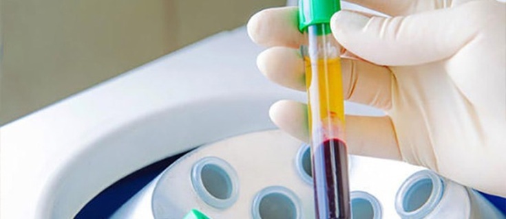 Plasmolifting para queda de cabelo