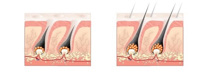 Óleo de limão para cabelo